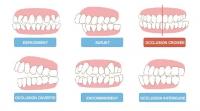 Pourquoi votre ostéopathe vous parle de vos dents et de votre occlusion ?